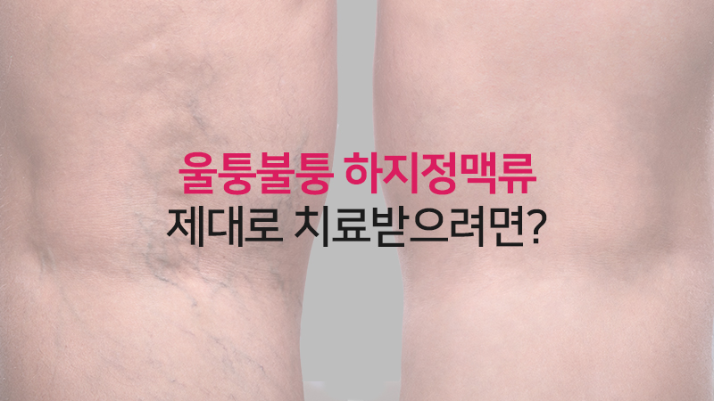 울퉁불퉁 하지정맥류, 제대로 치료받으려면…